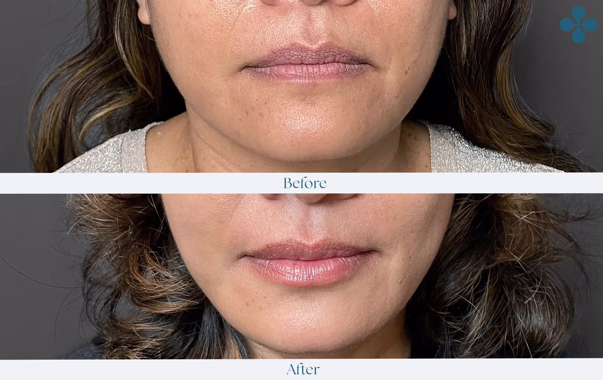 Melasma voor