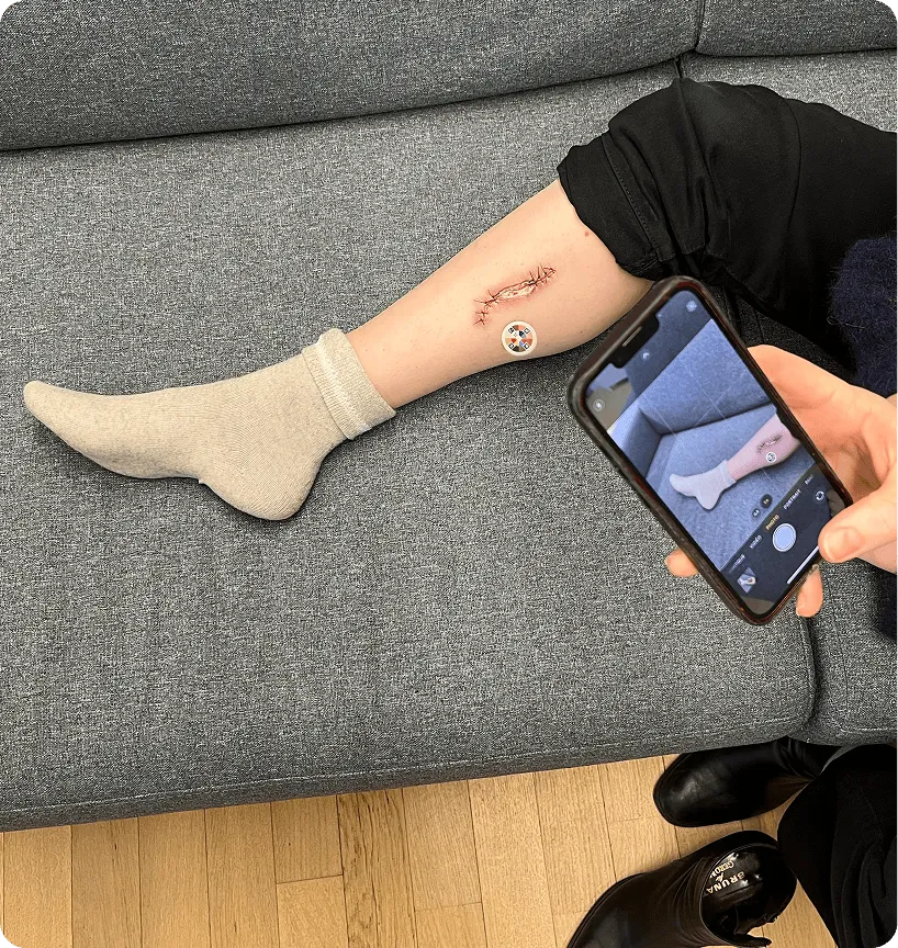 Eine Person fotografiert eine Narbe mit der Pixacare-App