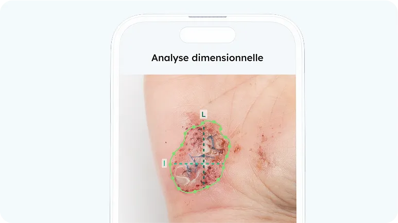 analyse dimensionnelle d'une plaie à l'aide de l'application Pixacare