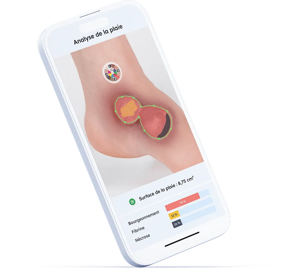 Mesure et analyse des plaies grâce à l'application Pixacare