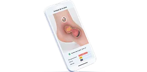 analyse d'une plaie sur l'application pixacare