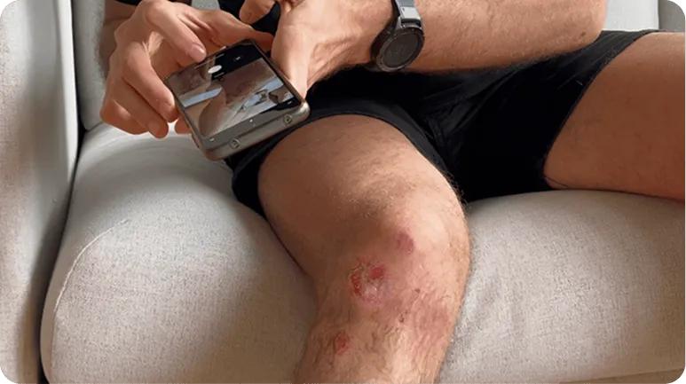 a man takes a photo of his leg wound