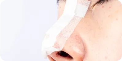 vue d'un nez après une intervention chirurgicale