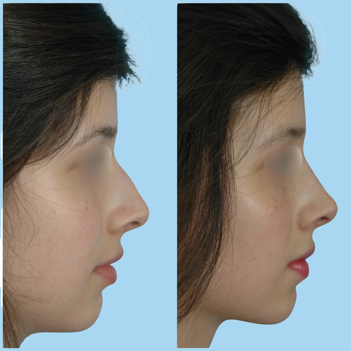 Female pre and post nose surgery