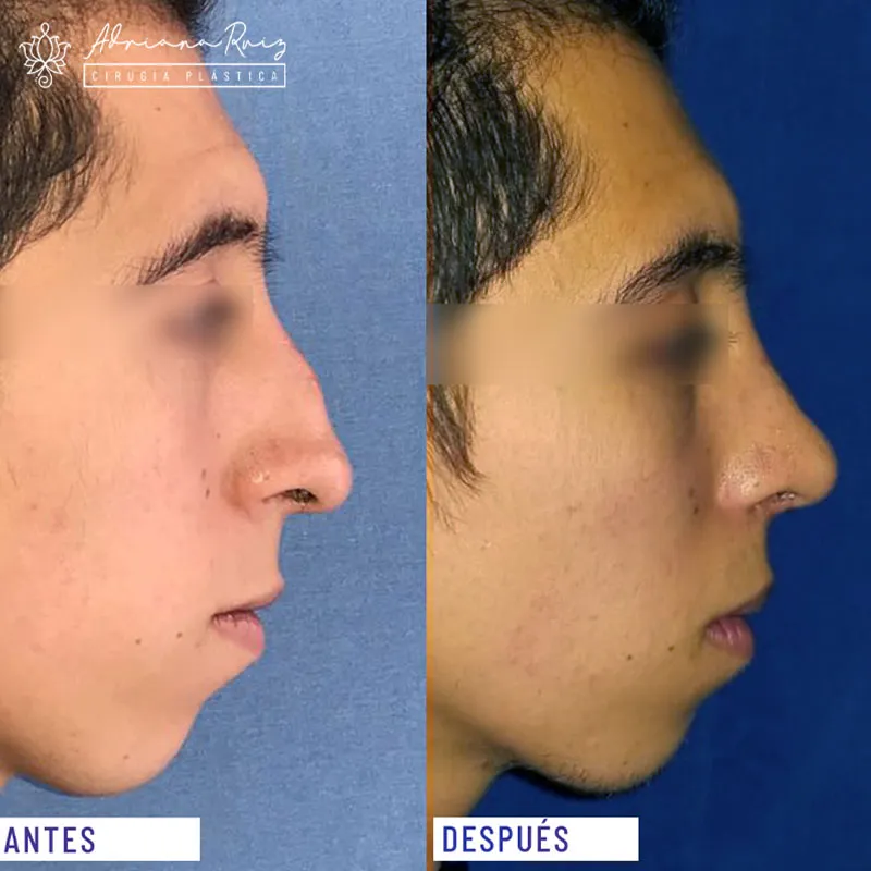 antes y despues rinoplastia
