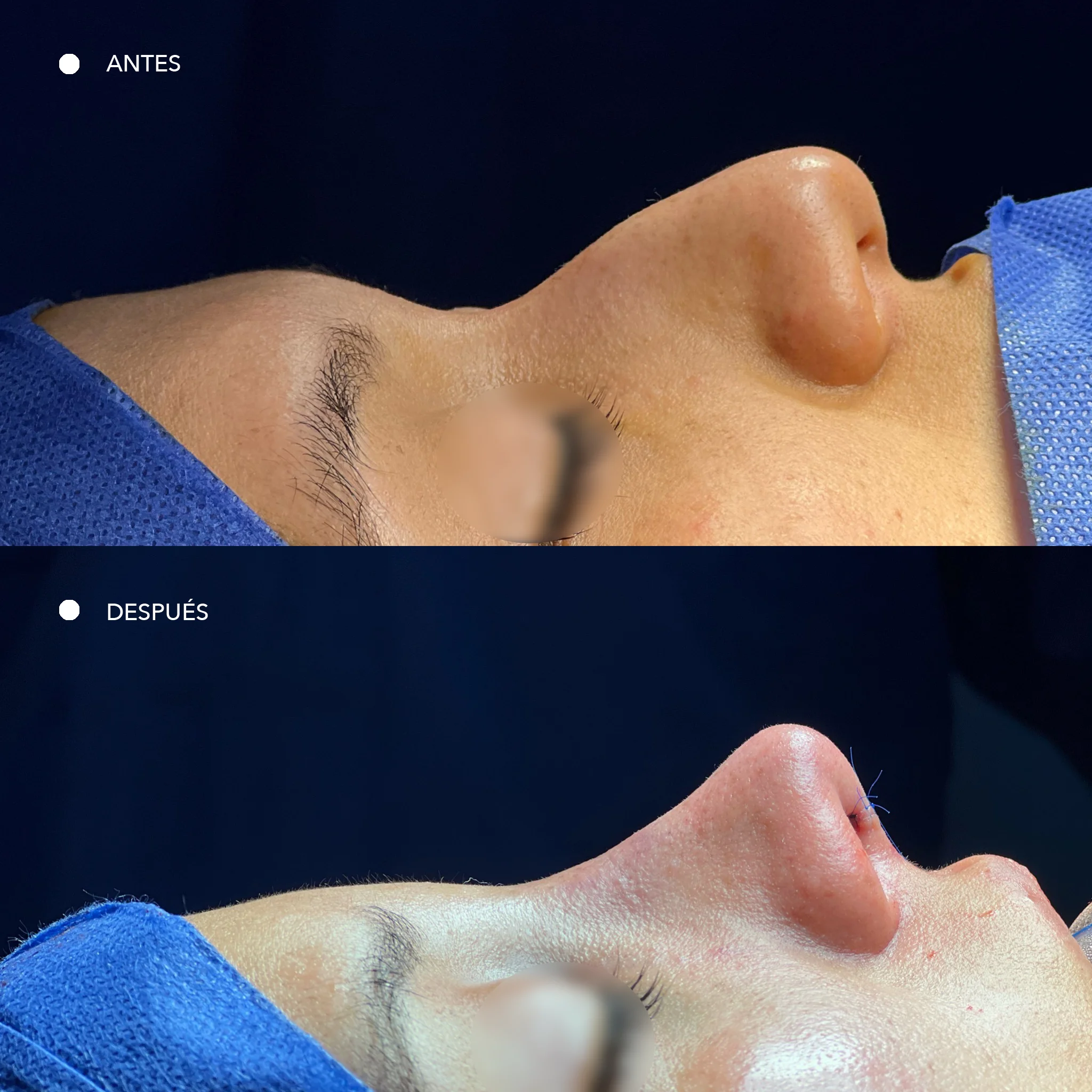 antes y despues de paciente de rinoplastia