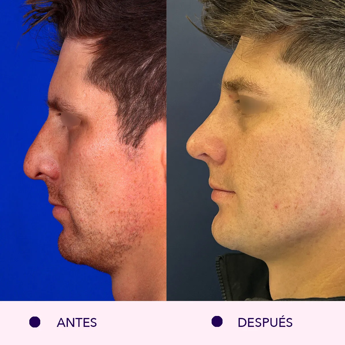rinoplastia antes y despues