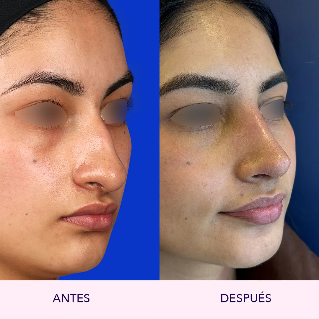 rinoplastia en bogotá antes y después