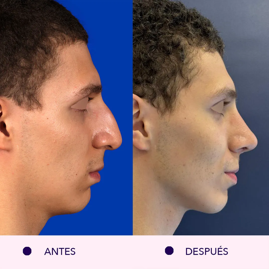 rinoplastia ultrasonica antes y despues