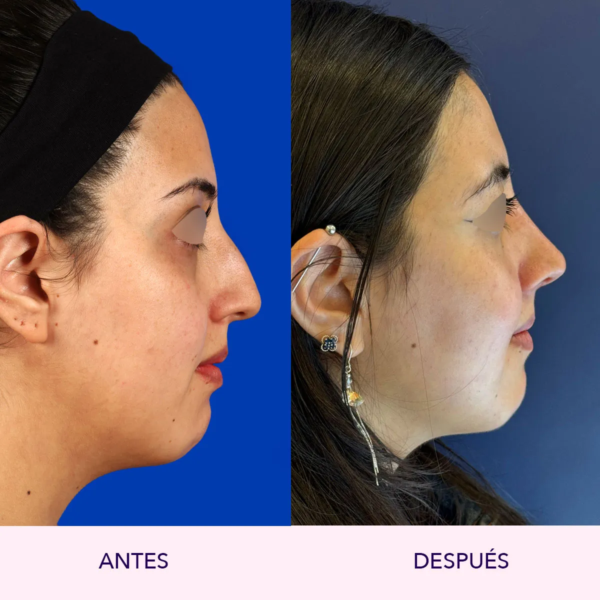 rinoplastia ultrasonica bogota antes y despues