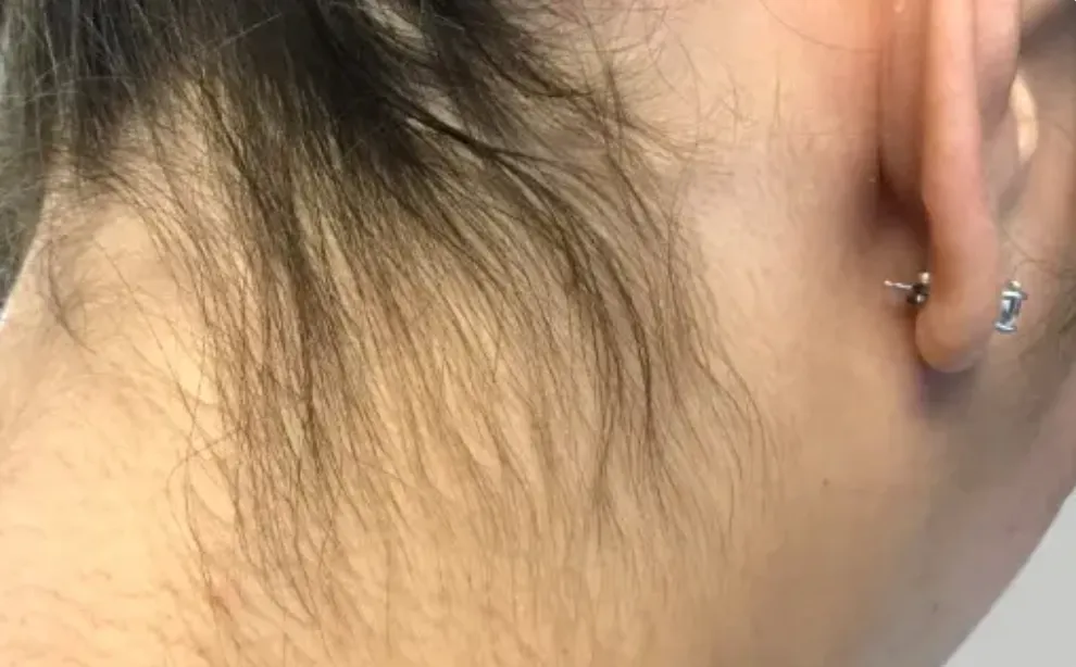 laser hair removal from neck by newday medspa