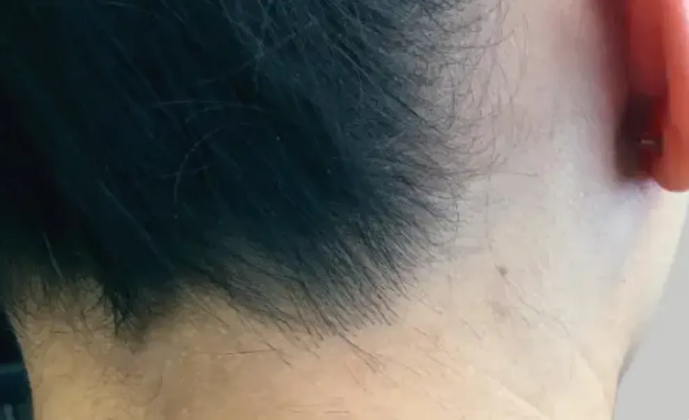 laser hair removal from back nack by newday medspa
