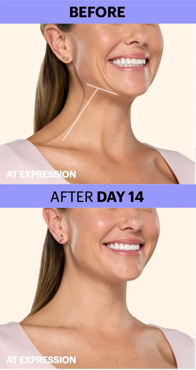 women improvment in wrikle After a botox treatment from newday medspa