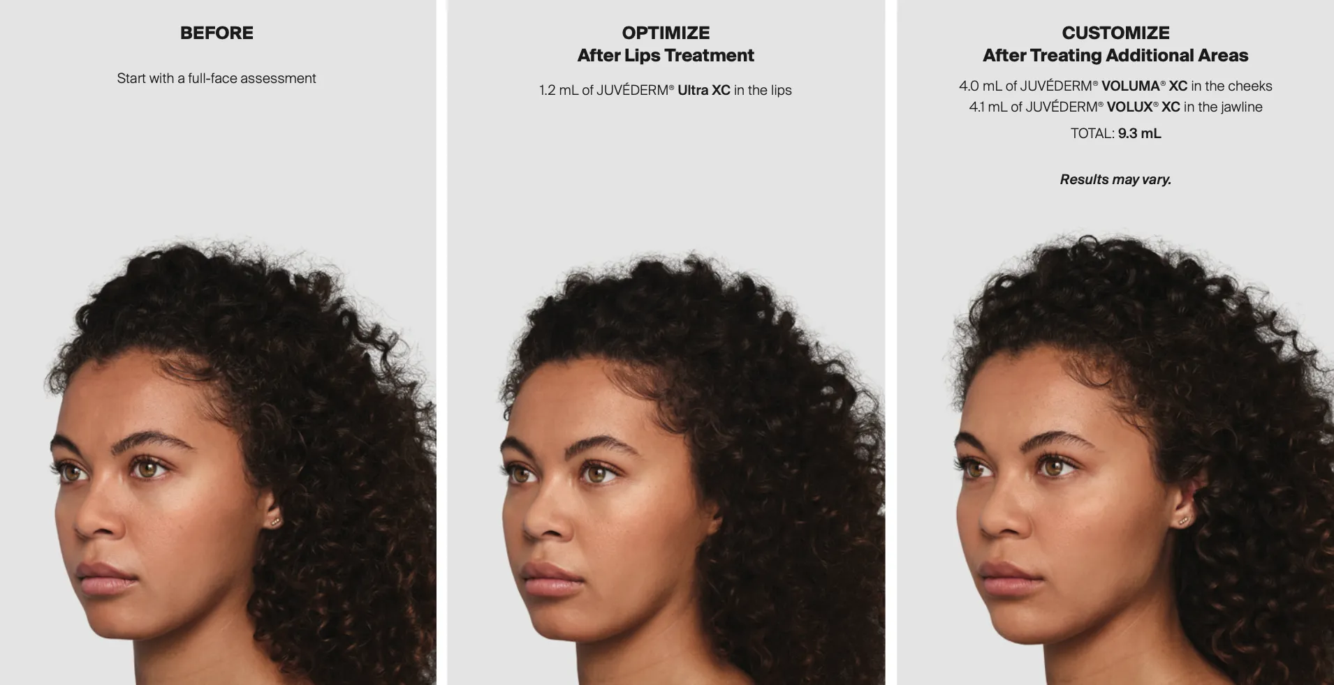 Side-by-side images of a woman showing before, after lips filler treatment,  with Juvéderm products.
