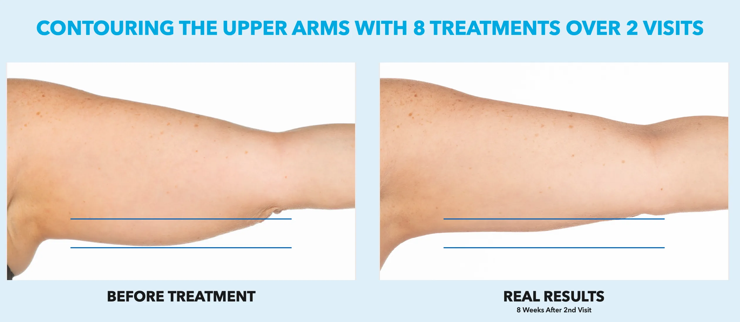 Underarm Cool Sculpting offer by new day medspa jacksonville florida