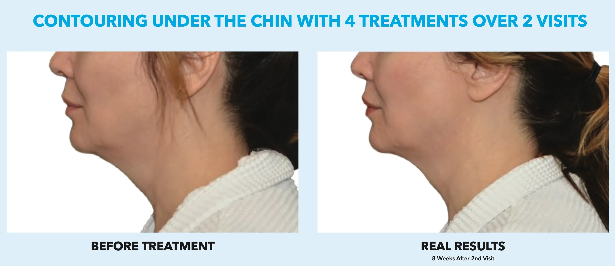 Chin Cool Sculpting offer by new day medspa jacksonville florida