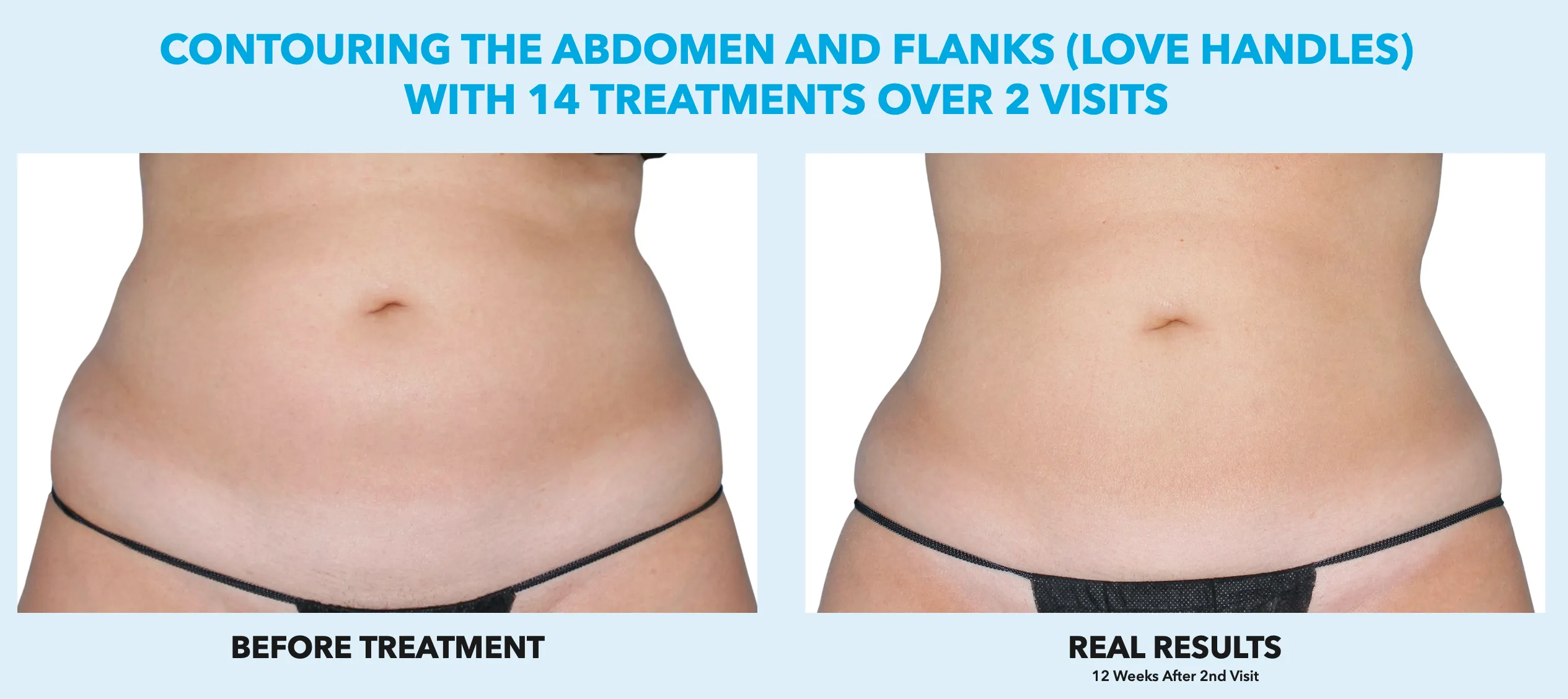 abdomen Cool Sculpting offer by new day medspa jacksonville florida