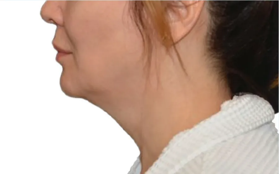 Chin Cool Sculpting offer by new day medspa jacksonville florida	