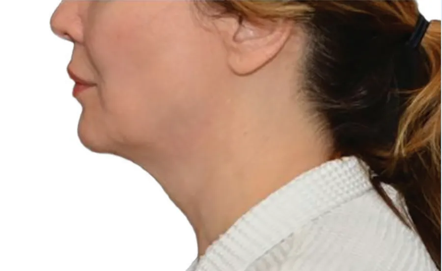 Chin Cool Sculpting offer by new day medspa jacksonville florida	