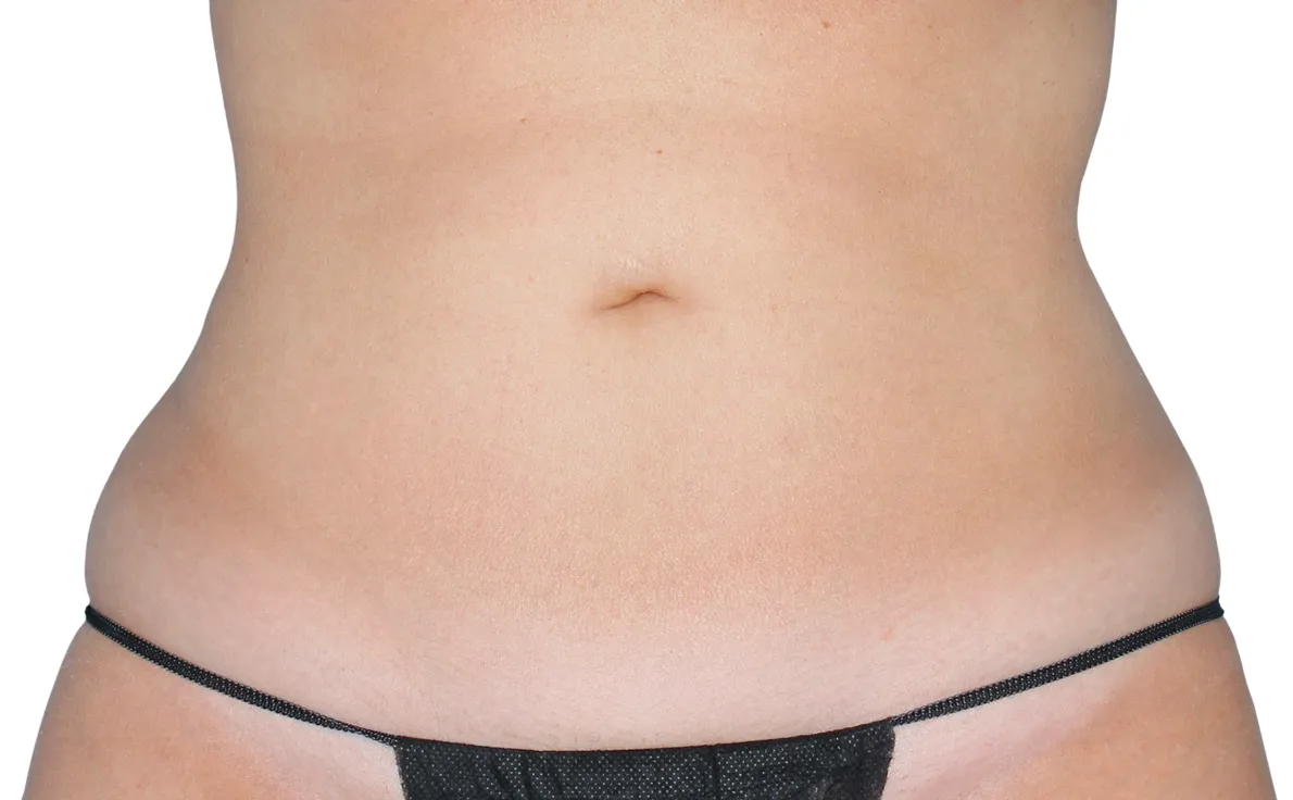Cool Sculpting offer by new day medspa jacksonville florida	