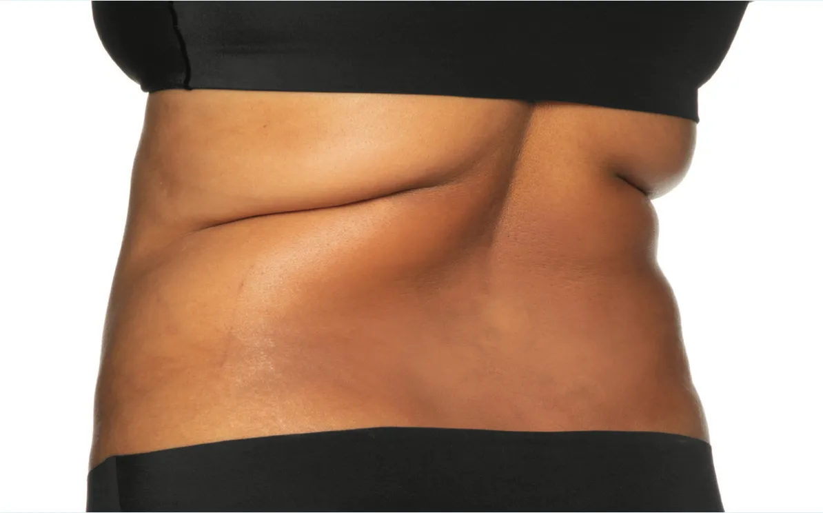 Cool Sculpting offer by new day medspa jacksonville florida	