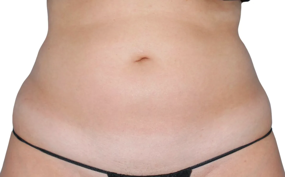 Abdomen Cool Sculpting offer by new day medspa jacksonville florida	
