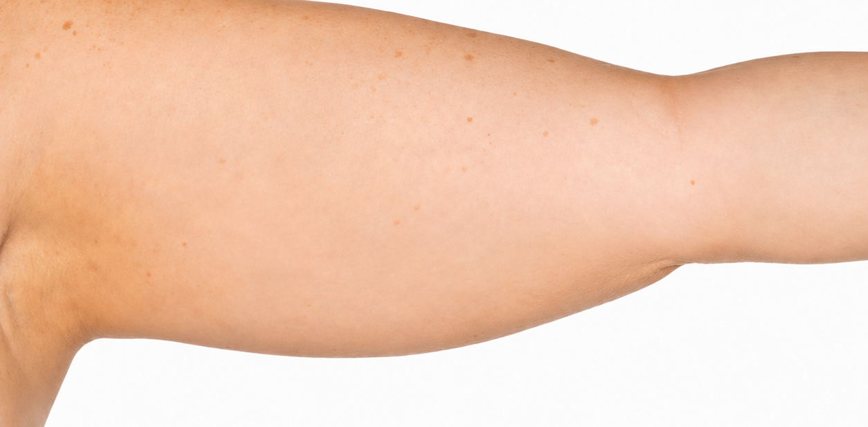 CoolSculpting before photo, New Day Medspa patient