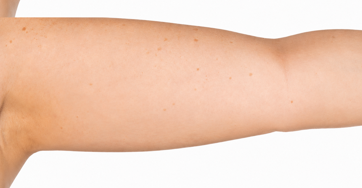 CoolSculpting after photo, New Day Medspa patient