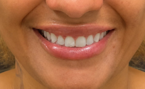 Laser hair removal result 4