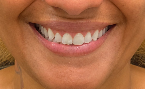 Laser hair removal result 3
