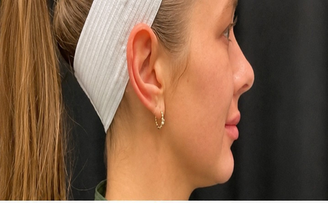 Jawline filler before photo