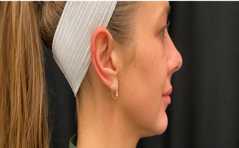 Jawline filler after photo