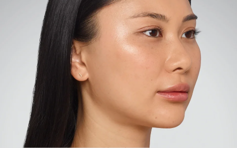 Cheek filler result 1 after