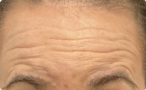 CoolSculpting before photo, New Day Medspa patient