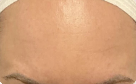CoolSculpting after photo, New Day Medspa patient