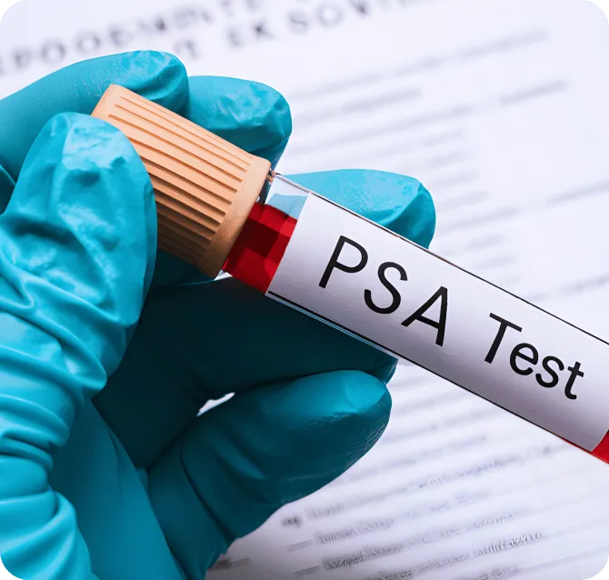 Elevated PSA (Prostate-Specific Antigen)