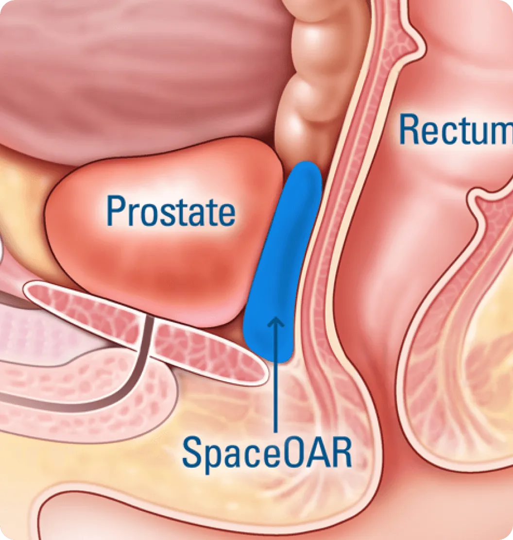 How Is SpaceOAR Placed?