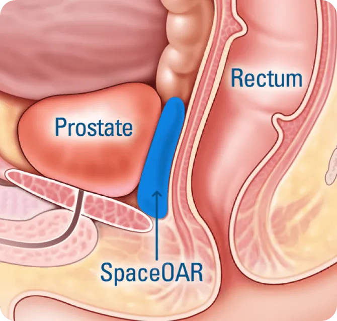 How Is SpaceOAR Placed?
