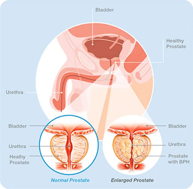 Robotically controlled, heat free waterjet removes prostate tissue during Aquablation therapy