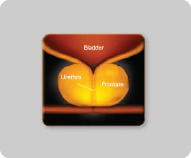 Enlarged Prostate