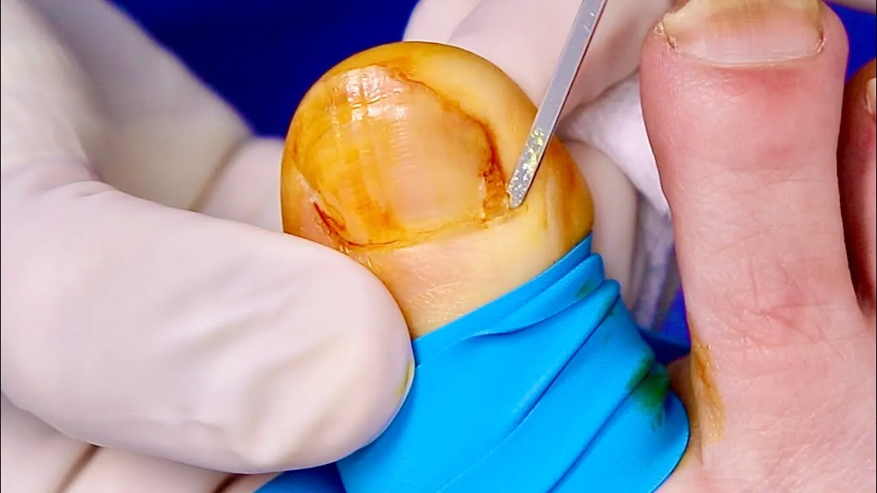 Her hangnail turned into an ingrown nail?!?!