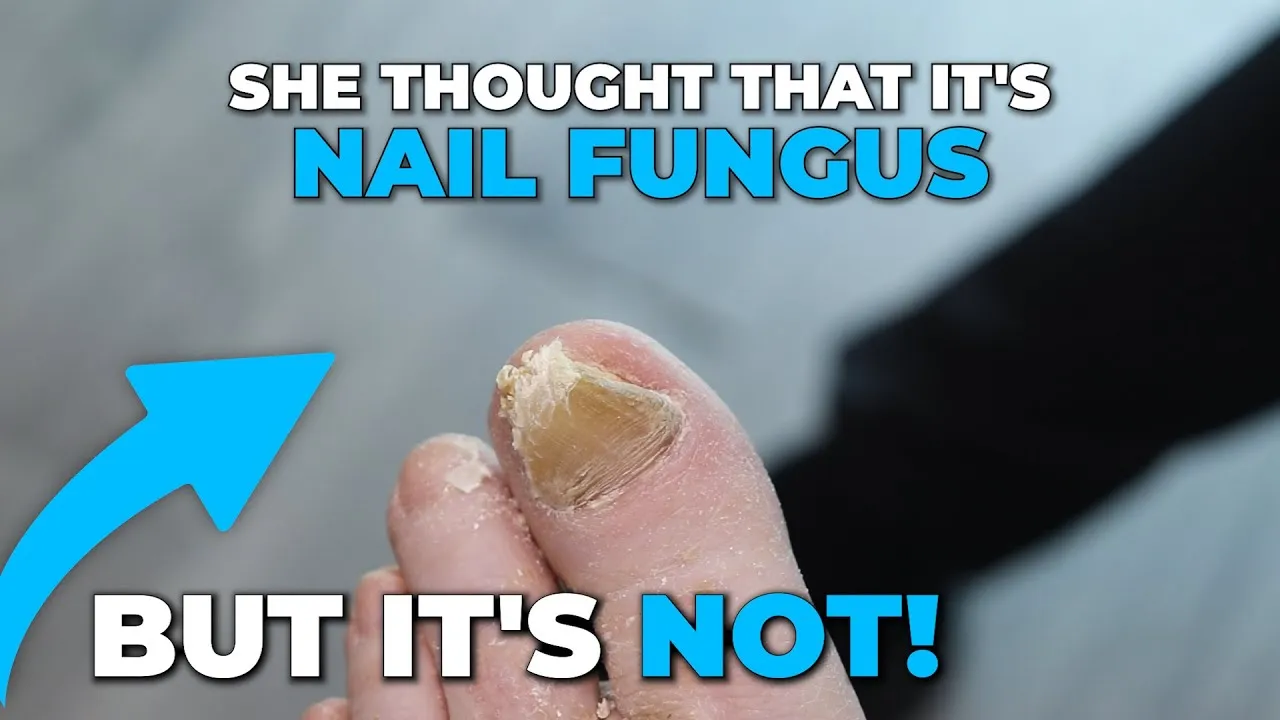 If it's not a nail fungus then what is it?!