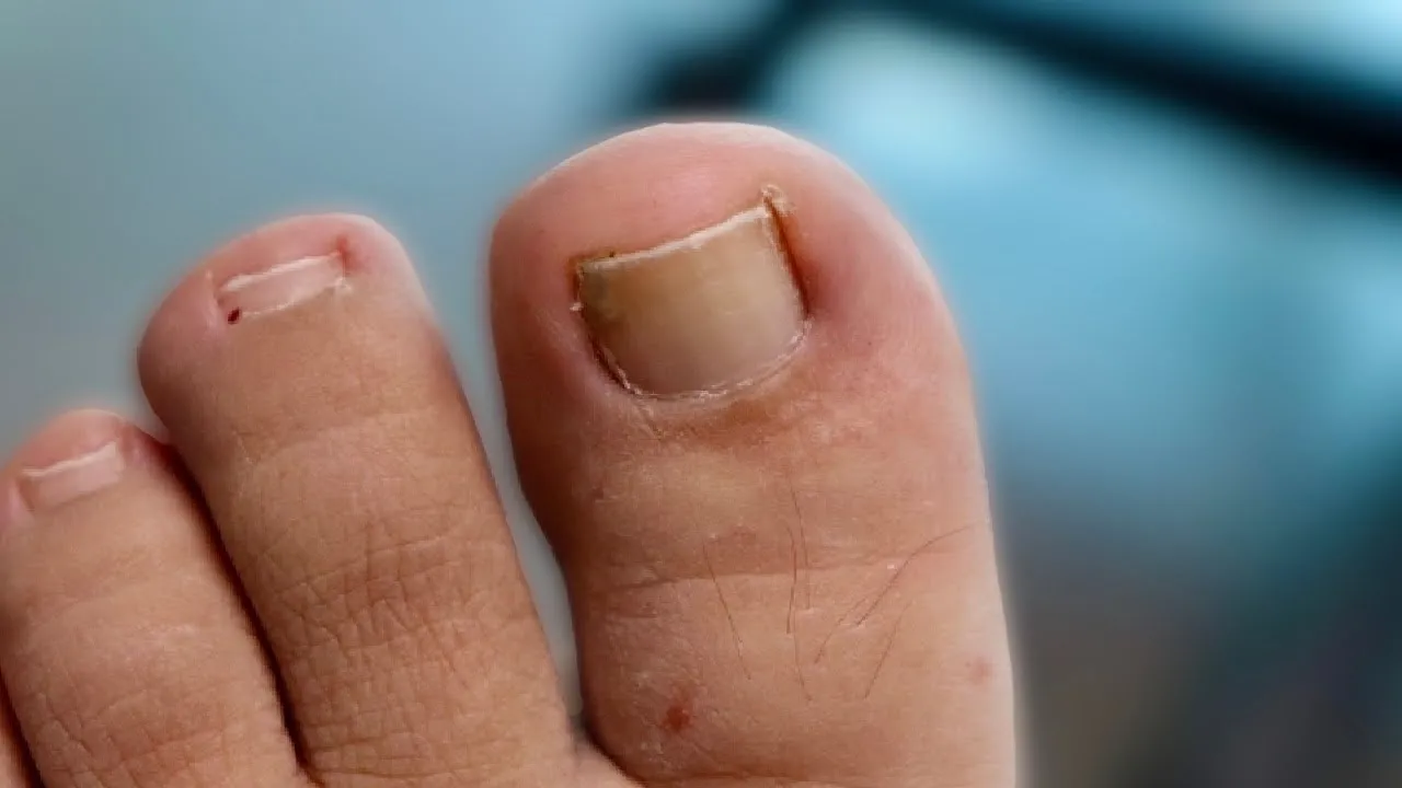 Satisfying ingrown toenail removal | Permanent fix!!!