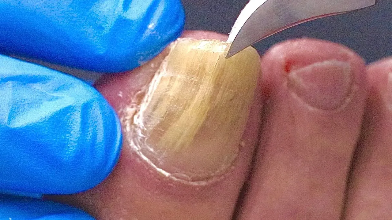 Trimming a thick fungal toenail!!!