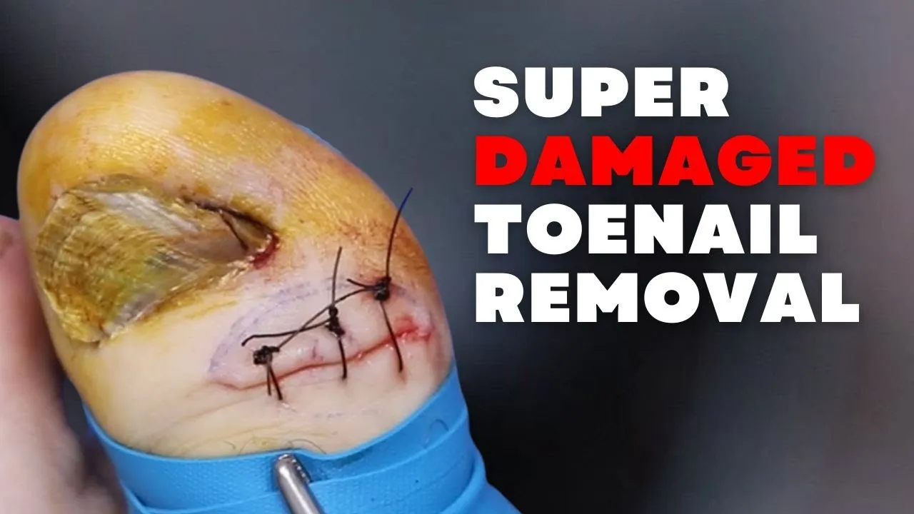 Super damaged toenail removal
