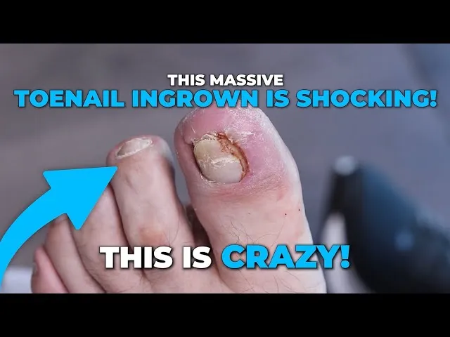 How did his toenail end up this bad?!