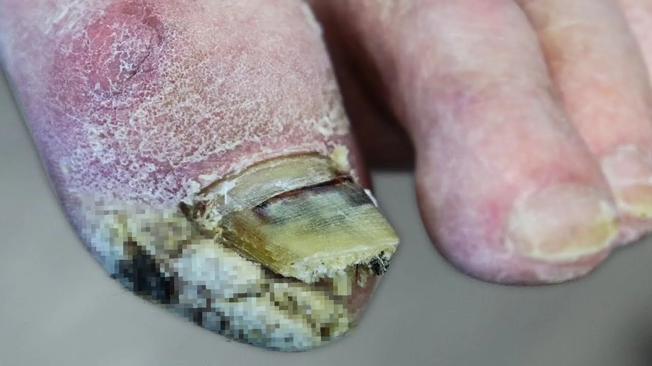 Did it grow back on his foot?  ***diabetic foot growth update***