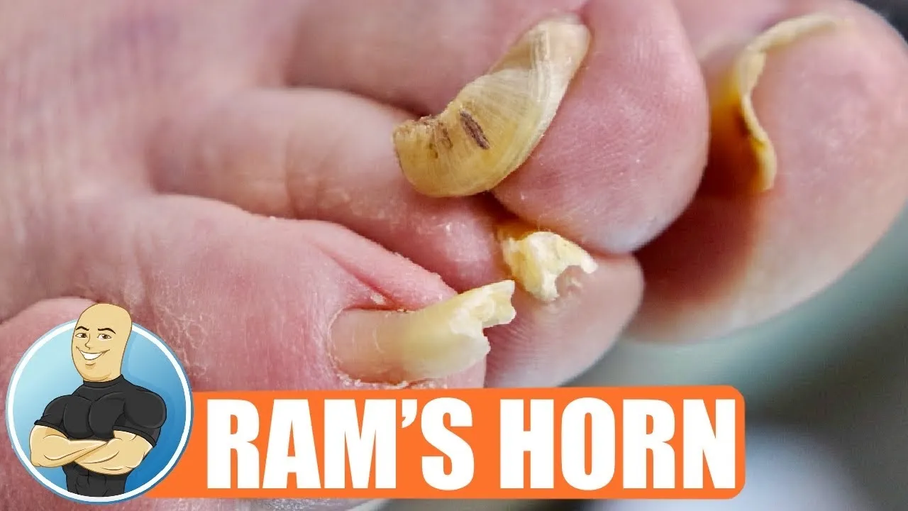 Trimming a ram's horn toenail