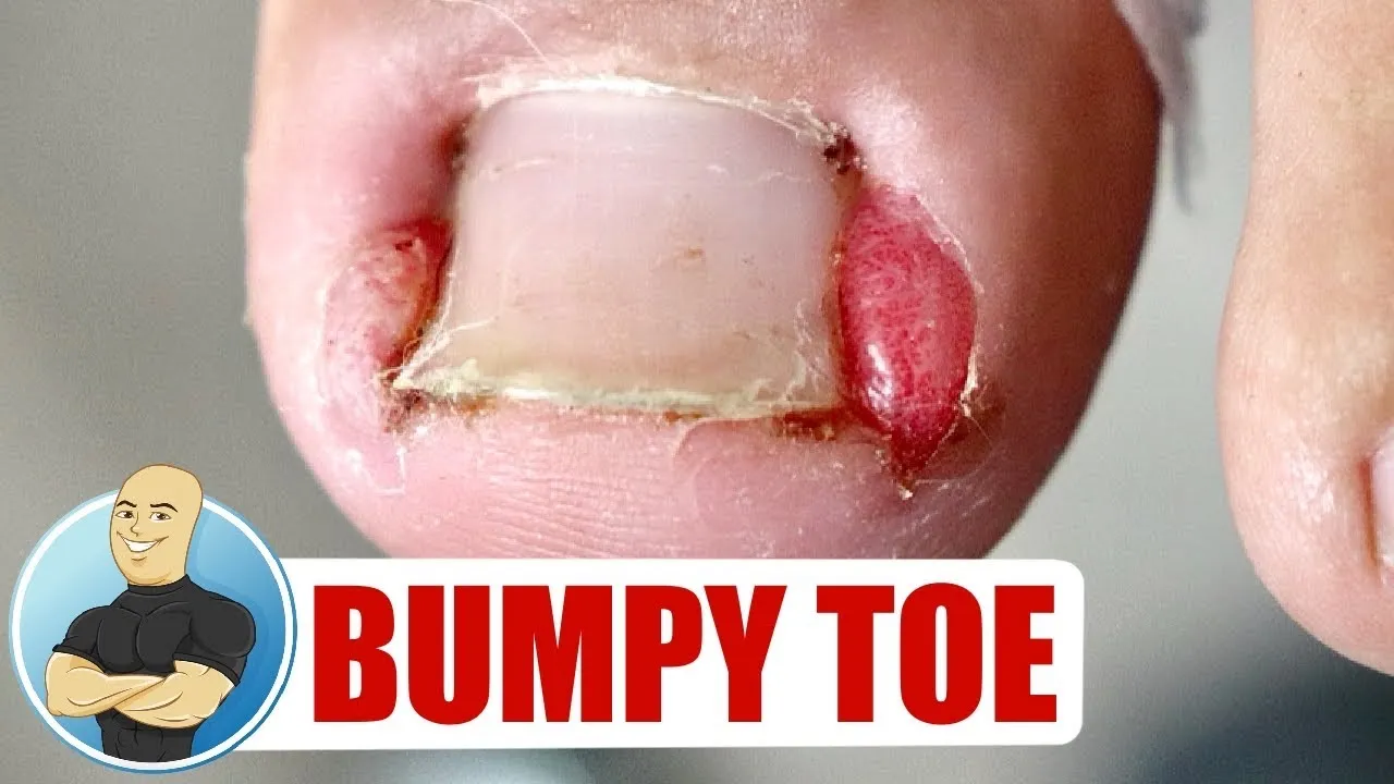 Big boy with a big ingrown toenail!!!