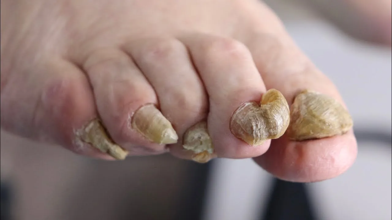 Trimming super long toenails ***never cut for over 2 years***